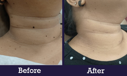 Before After neck 1