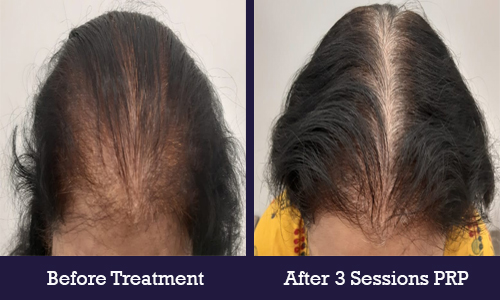 Before Treatment and After 3 Sessions PRP