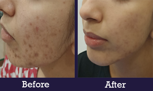 Before After Skin2